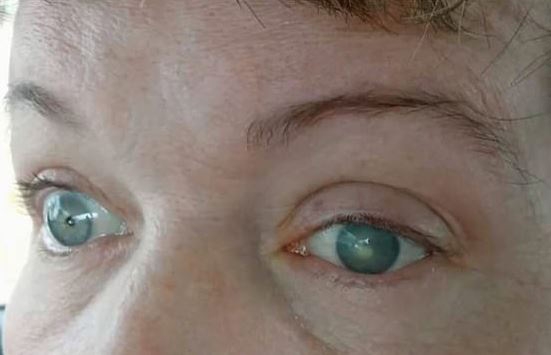 가시아메바 각막염이 발생해 눈에 손상을 입은 여성의 모습.