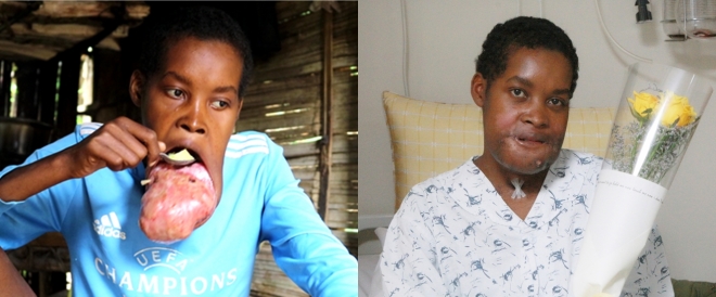 입안에 생긴 거대 종양으로 따돌림받던 마다가스카르 청년 플란지(22)가 서울아산병원에서 수술 후 새 삶을 찾았다. 사진은 수술 전후 비교.  서울아산병원