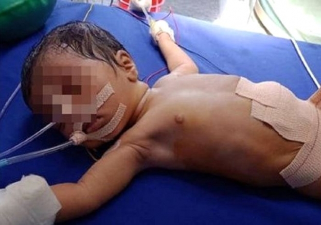 태어난 지 21일 된 신생아의 뱃속에서 8명의 태아가 발견됐다. 최근 인도 매체 ‘NDTV’의 보도에 따르면 인도 자르칸드주의 한 사립 병원에서 태어난 신생아의 복부에서 태아가 발견됐다. ‘NDTV’ 보도 캡처 