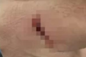 “손 영구손상 위험”…주호민, 강도 피해 사진