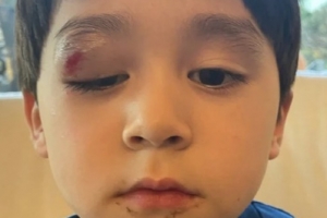 벤틀리, 놀이터서 눈 쪽으로 떨어졌다…눈 뜨기 어려울 정도