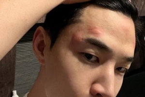 헨리, 퉁퉁 부은 얼굴…“최악, 복수할 수도 없고”