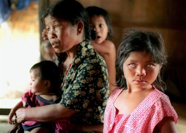 베트남 중부의 한 마을에서 맹인으로 태어난 7살 소녀(오른쪽 첫 번째). 베트남전쟁 당시 미군이 살포한 고엽제로 인해 이 마을에서 태어난 아이 1078명 중 272명이 장애를 안고 있다. AP 연합뉴스