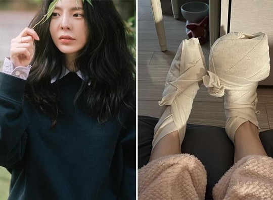 가수 장재인이 발에 2도 화상을 입었다고 밝혔다. SNS 캡처