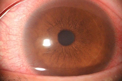 잘못된 콘택트렌즈 사용으로 극도로 충혈된 눈. 대한안과학회지