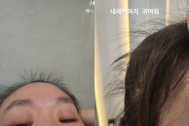 출산 100일 후 머리카락 환자처럼 빠졌다”…산후 탈모, 어떻길래 | 서울신문