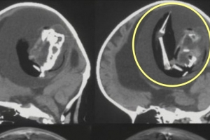 1세 아기 두개골에…또 다른 ‘쌍둥이’ 자라고 있었다