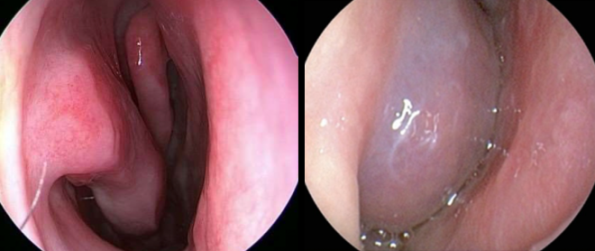 알레르기 비염 환자(오른쪽)의 코점막과 정상 상태(왼쪽)의 사진.  서울아산병원 제공