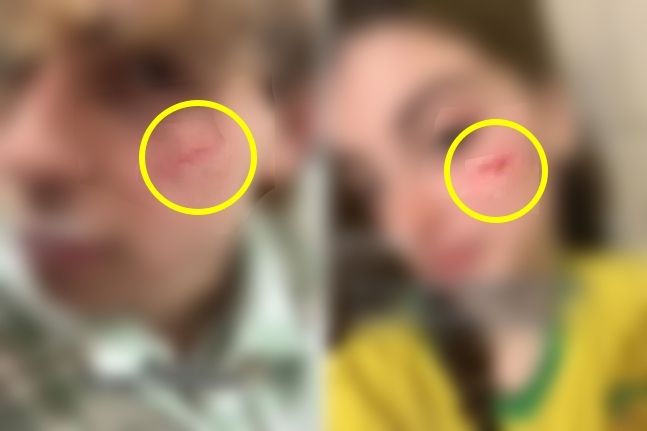 이탈리아 10대들 사이에서 유행 중인 ‘프렌치 흉터 챌린지’ . 틱톡 영상 캡처