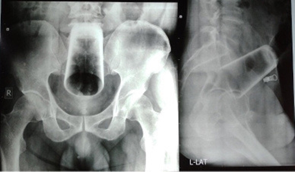 몸 속에 유리컵이 박힌 채 병원을 찾은 네팔 남성의 엑스레이 사진.  네팔의료협회 저널
