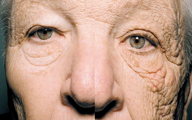28년간 자외선에 노출되 심하게 손상된 트럭운전사의 왼쪽 얼굴모습. New-England-Journal-of-Medicine