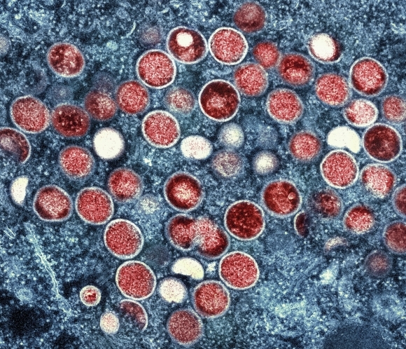 엠폭스(원숭이두창) - 미 국립 알레르기·전염병연구소(NIAID)가 전자현미경으로 촬영한 뒤 색처리한 엠폭스(MPOX·옛 명칭 원숭이두창)에 감염된 세포. 감염된 세포(파란색) 내에 엠폭스 입자(빨간색)가 보인다.   AP 연합뉴스