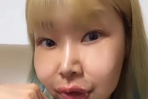 양악수술 후 확 바뀐 ‘영자’ 정신이상설 나온 사진
