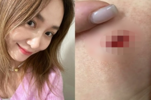 “피가 폭포처럼 줄줄”…옥주현, 심각했던 사고 사진 공개