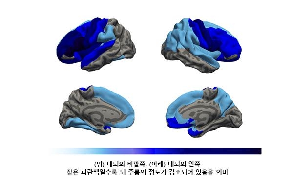 (위) 대뇌의 바깥쪽과 (아래) 대뇌의 안쪽. 푸른색이 짙을수록  뇌 주름의 정도가 감소되어 있음을  의미한다. 고려대 안암병원 제공