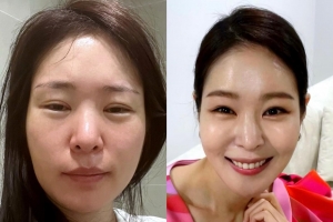 “완전 다른 사람” 미자, 충격적인 얼굴 부기 ‘비포·애프터’
