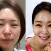 “완전 다른 사람” 미자, 충격적인 얼굴 부기 ‘비포·애프터’