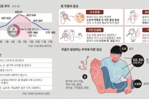 가렵고 성가신 무좀 피하려면… 구두부터 벗어야겠네