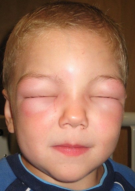 알레르기성 혈관부종. 부종으로 인해 눈을 뜨지 못한다. 위키백과 캡처