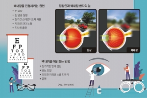 시야가 뿌옇고 답답한 백내장… 인공수정체 삽입 수술로 해결해야