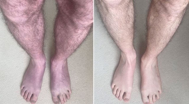 영국 33세 남성이 서 있은 지 10분가량 지나자 다리가 푸른색으로 바뀌어 있다(왼쪽). 남성은 코로나19에 걸린 뒤 이런 증상이 시작됐다고 주장하고 있다. 영국 리즈 대학교