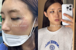 얼굴 피멍·손목 골절…현아, 아찔한 사고 당했다
