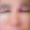 “눈밑지방재배치 수술 하루 만에 시력을 잃었습니다”
