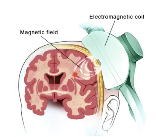 ‘경두개자기자극’(Transcranial Magnetic Stimulation·TMS) 치료의 원리. 미국 메이요 클리닉 홈페이지 캡처