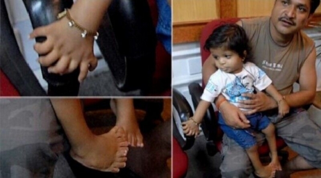 2011년 인도에서 손가락 14개, 발가락 20개를 가진 1살 남자아이. 헤럴드선 캡처