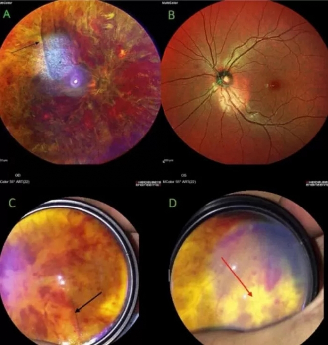 실명된 남성의 안구 사진. Journal of Medical Case Reports