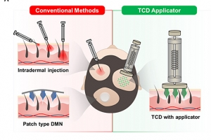 연세대, 마이크로니들 기술 기반 원형탈모 치료제 개발