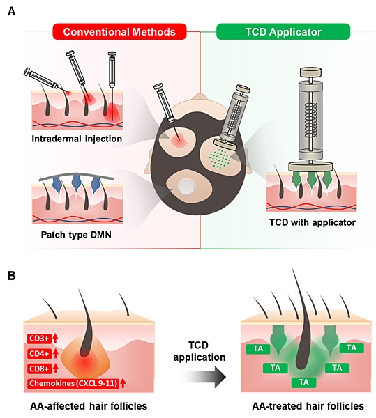 TA-encapsulated Candlelit-dissolving Microneedle(TCD)의 투여 원리. TCD는 기존 용해성 마이크로니들 패치와는 달리 단시간에 적용되는 이식제 형태를 가진다. 연세대 제공