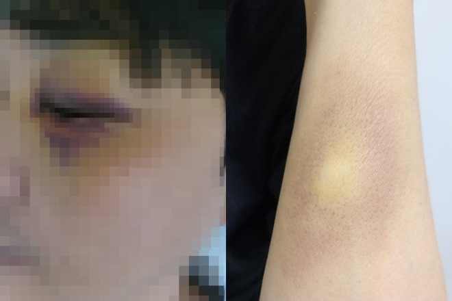 지난달 22일 경기 김포시의 한 아파트 단지에서 초등학생 아이의 아버지에게 폭행당했다는 A씨 남편의 피해 모습. 보배드림 캡처.