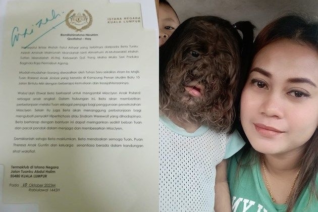 ‘늑대인간 증후군’을 가진 미스클리엔(2·왼쪽)의 부모가 말레이시아 왕비로부터 받은 편지를 공개했다. 페이스북