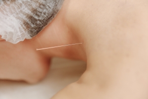 목사가 한의사 행세… 女신도 가슴에 침놓다가 ‘사망’