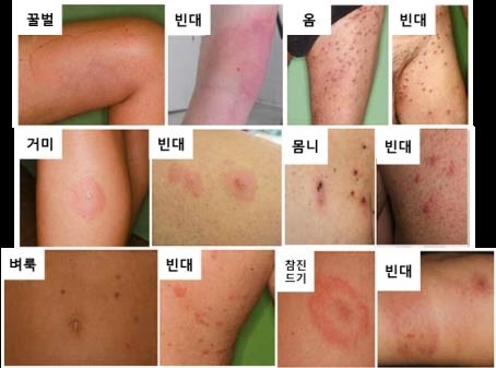 빈대와 다른 곤충에 물렸을 때의 교상 흔적 비교  질병관리청 제공