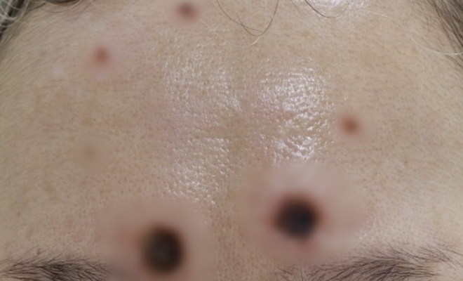 일본에서 ‘점 빼기 크림’을 사용했다가 피부가 괴사된 여성의 사진. NCAC 홈페이지 캡처