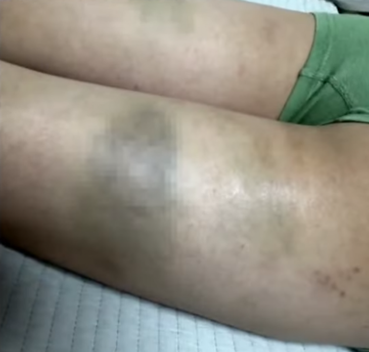 담임교사에게 허벅지에 피멍이 들 정도로 체벌받은 초등학교 5학년 아이. JTBC ‘사건반장’ 캡처