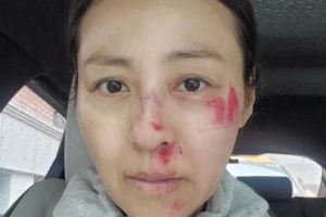 전혜진 끔찍한 사고…“얼굴에 피와 진물, 긴급 드레싱”