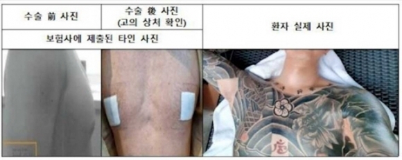 보험사에 제공된 가짜 사진(왼쪽)과 가짜 환자의 실제 사진. 서울경찰청 제공