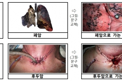 구멍 뚫린 목, 괴사된 발…이래도 담배 피우시겠습니까?