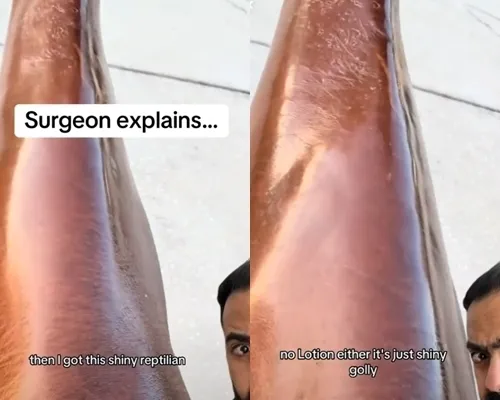 틱톡에서 530만명 이상의 팔로워를 보유한 NHS 외과 의사인 카란 라지 박사도 이 증상에 대해 경고했다. 카란 라지 박사 틱톡 캡처