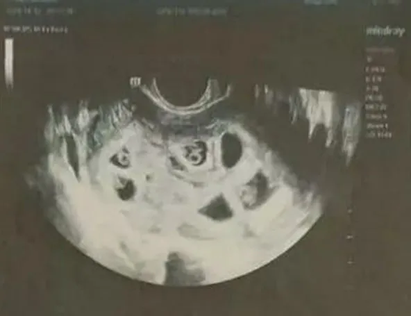 아홉 쌍둥이를 임신했던 여성의 초음파 사진. 사우스차이나모닝포스트(SCMP) 캡처