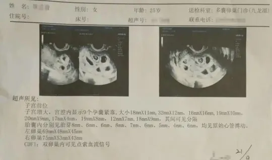 아홉 쌍둥이를 임신했던 여성의 초음파 사진. 바이두 캡처