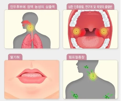 질병관리청 국가건강정보포털에서 설명하는 성홍열 증상.