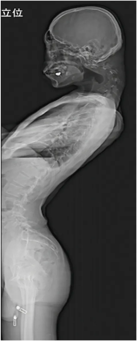 환자의 척추가 장기간의 부자연스러운 자세로 인해 크게 변형된 모습. 일본정형외과 학회지(JOS)의 사례 연구집 논문 캡처