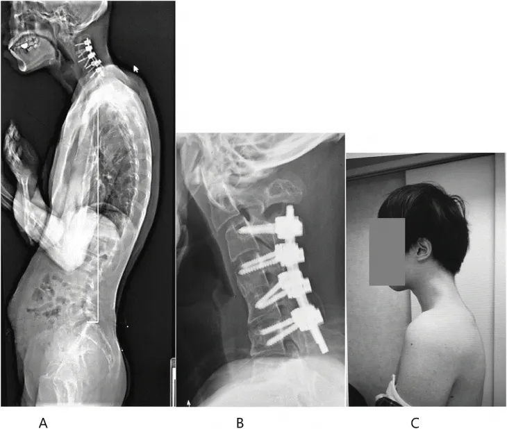 수술 후 호전된 척추와 목뼈 상태. 일본정형외과 학회지(JOS)의 사례 연구집 논문 캡처