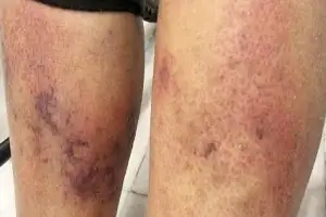 ‘치사율 50%’ 병원균, 전남 갯벌서 올해 첫 검출…당국, 예방수칙 당부