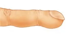 곤봉지 증상이 나타난 손가락 모양. 자료 : 서울대병원