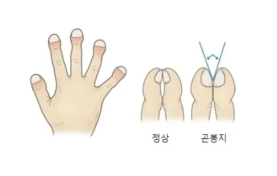 곤봉지 증상이 나타난 손 모양(왼쪽)과 곤봉지 여부를 진단하는 방법(오른쪽). 자료 : 서울아산병원